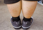 Cesariana contribui para obesidade abdominal, mostra pesquisa da USP - China Photos/Getty Images